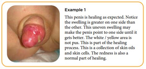 An inability to bend your leg 3. 4 Weeks After Circumcision Pictures - Public Health