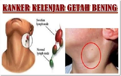 Karena itu, selayaknya kanker payudara. Info Kesehatan: KANKER GETAH BENING DAN PENGOBATANNYA