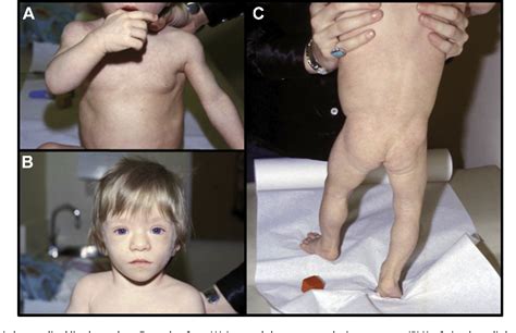 Endocrine diseases, fetal diseases, genetic diseases, rare diseases, skin diseases. Figure 1 from Biallelic mutations at PPARG cause a ...