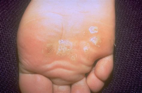 Plantar warts are usually flat rather than plantar warts are most common on the parts of the foot that receive the most pressure when you're standing or walking, increasing the pressure on. Types of Warts and How to Treat Them - A Visual Guide | Allure