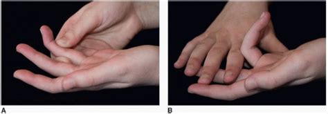 Weakness of the fpl and fdp muscles is manifested by an inability to oppose the tips of the thumb and index finger but may be seen only if compression is several provocative tests can further confirm cts. Zone II Flexor Tendon Repair | Musculoskeletal Key