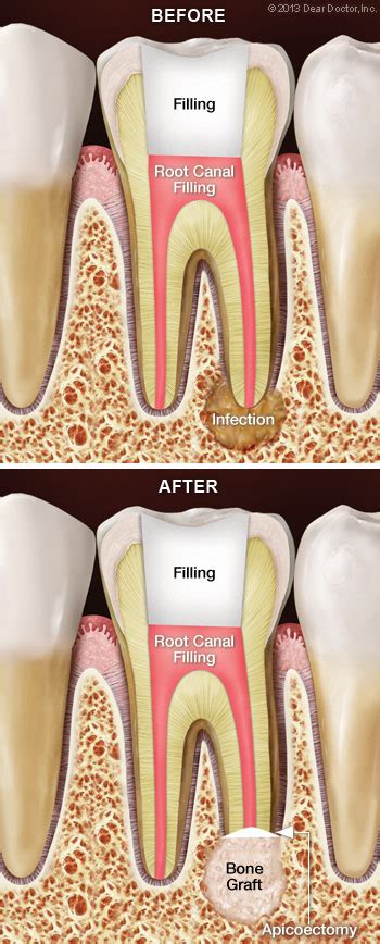 Mustard oil and table salt can strengthen a loose tooth. Root Canal Surgery | Endodontist | Tooth Pain | Norwalk ...