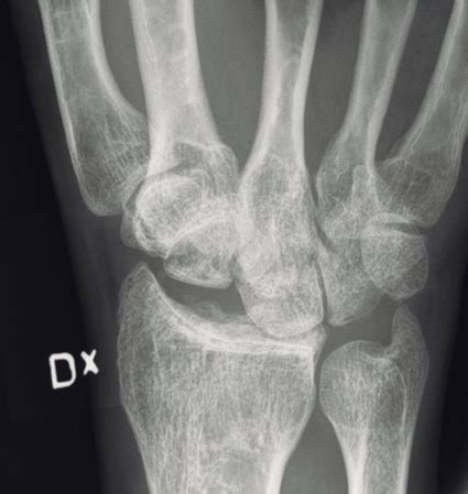 Der tfcc besteht neben dem diskus ulnokarpalis auch aus dem meniskus ulnokarpalis und den palmaren und dorsalen bandstrukturen (siehe schmidt/ lanz „ chirurgische anatomie der hand). Handledens ligamentskador - behandling - Läkartidningen