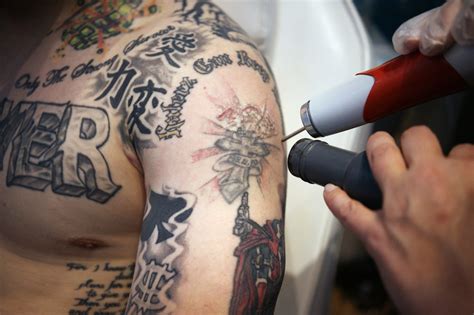 This laser has a photoacoustic effect that gently targets the ink using sound energy rather than heat. Laser Therapy Is An Easy Process To Remove Body Tattoos ...