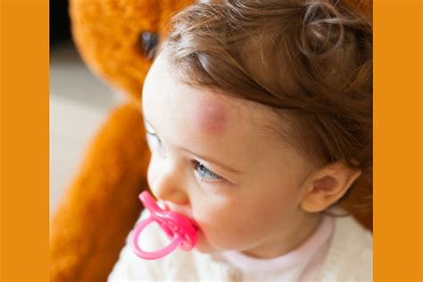Bayi mengalami kuning tidak hanya matanya saja, biasanya diiringi dengan kuning di kulit dan sakit mata kuning ini, pada dasarnya tidak berbahaya. 5 Langkah Ampuh untuk Mengatasi Benjol pada Bayi