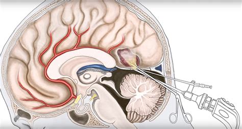 Hemangioblastoma Treatment | Pacific Brain Tumor Center