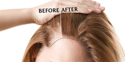 Men tend to convert the excess dhea into estrogen, which can cause decreased libido or fatigue. Vicks VapoRub to Stimulate Hair Growth: Does it Work? 2020 ...