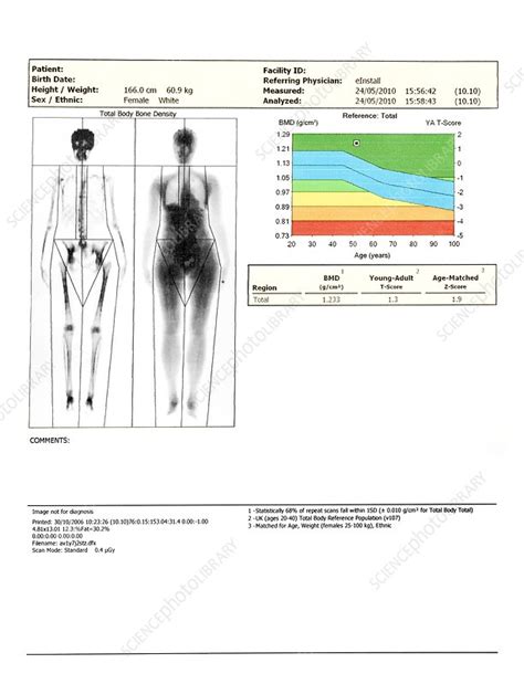 Bone scans require an injection beforehand and are usually used to detect fractures, cancer test results may not be accurate in people who have structural abnormalities in their spines, such as severe arthritis, previous spinal surgeries or scoliosis. Bone density scan - Stock Image - C019/7429 - Science ...