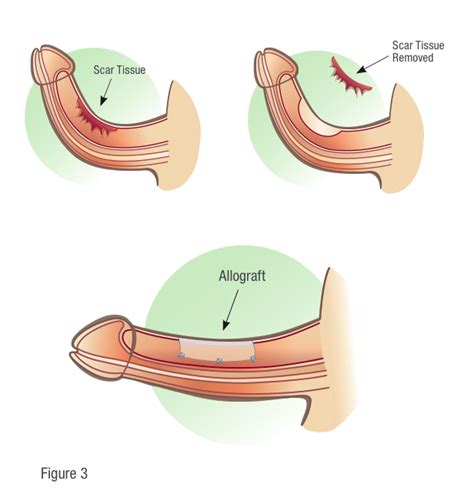 Treating erectile dysfunction — without the little blue pill. Allograft Surgery | Coloplast Men's Health