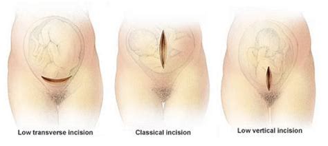 Sapu losyen diseluruh badan, terutamanya perut. X-presi by Kemn Azmaili: Cara Berpantang: C-section LSCS ...