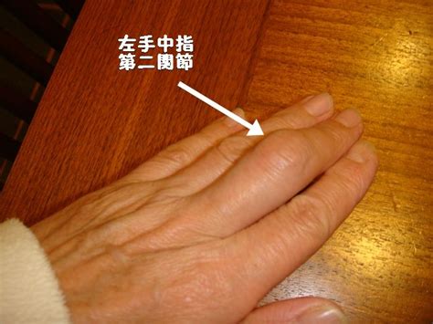 手指の変形性関節症 : アリーがやって来た （ベックもいるよ）