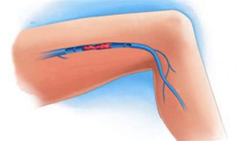 Blodpropp i beinet kan gi symptomer som rødlighet, kløe, hevelse og smerter i det påvirkede området. Noen symptomer på blodpropp i bena - Veien til Helse