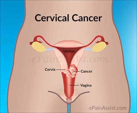 In many cases, cervical esophageal cancers can get quite large before patients become aware of symptoms. Is Cervical Cancer Curable|Survival Rate & Treatment of ...