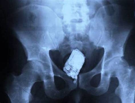 You may use this domain in literature without prior coordination or asking for permission. These 18 X-Ray Results Will Totally Boggle Your Mind ...