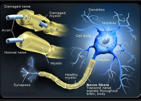 Când acest înveliş este deteriorat, impulsurile nervoase sunt încetinite sau oprite. SMart Choice Lifestyle: Ce este scleroza multipla?