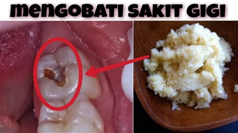 Cara merawat gigi palsu dengan baik dan benar agar gigi tidak bau atau senantiasa sehat. Cara Mengatasi Gusi Sakit Secara Alami