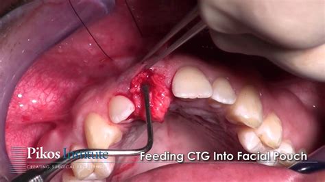 Clinical evidence of soft tissue covering periosteum is indicative of graft survival, even in the presence of persistent root exposure. Tunnel connective tissue graft - Bauer Smiles - SECTG - VISTA