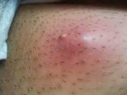 Anybody can get an ingrown hair. Ingrown hair