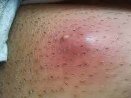 Here, we will share all that information with you. Ingrown hair