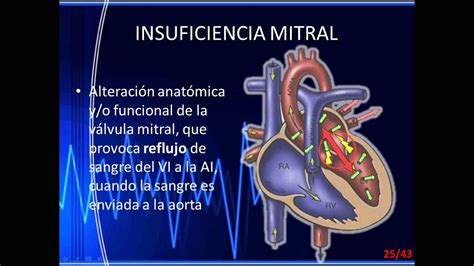 Estenosis mitral significa que la válvula no se puede abrir lo suficiente. estenosis mitral - YouTube