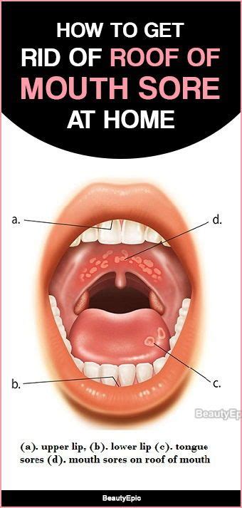 Do it like a pro. How to Get Rid of Roof of Mouth Sore | Mouth sores, Roof ...