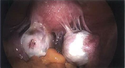 Pathogenetic implications of the anatomic distribution. Endometriosis | Women's Health Centre - Gold Coast