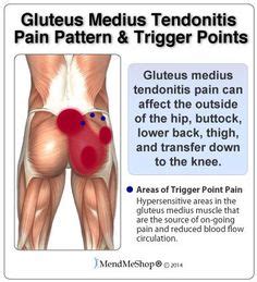Pain in your back radiating down into your buttocks but not typically extending into your legs. gluteal muscles color diagram - Google Search | Glute medius, Gluteal muscles, Glutes