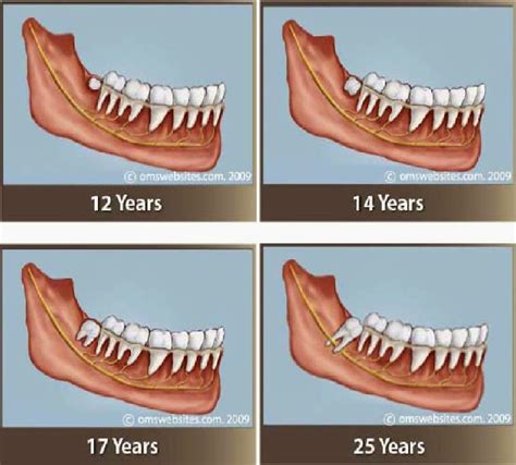 Removal of wisdom teeth is a permanent cure for recurring pericoronitis. Rosen's Rants