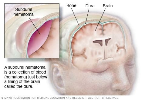 There are several types of hematomas, which are often described by their location (for example, under the fingernail, in the liver, spine read about the symptoms, signs, causes, diagnosis, treatment, and prevention of hematomas. Intracranial hematoma - Mayo Clinic