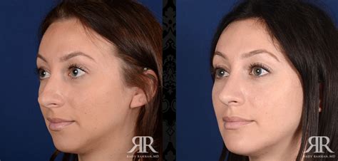 For this reason, it is typically recommended that you wait for at least three to four weeks after breast augmentation before entering a pool or submerging yourself in a bathtub. Pin by Rady Rahban, MD on Chin Augmentation | Rhinoplasty ...