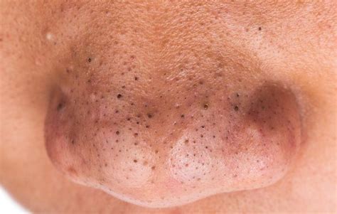 7 foolproof ways to get rid of blackheads. How to Get Rid of Blackheads on Your Nose | Men's Health