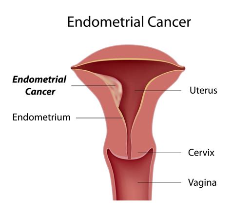 Fibroids are benign and do not grow into cancer; Bloody Discharge | causes, symptoms, treatment, how to get rid