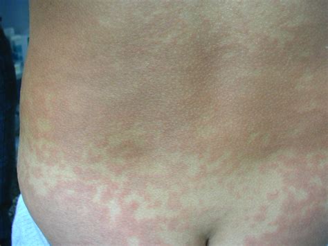 It's most common in teens and young adults. Il dottor Ferrando Alberto: Mononucleosi infettiva