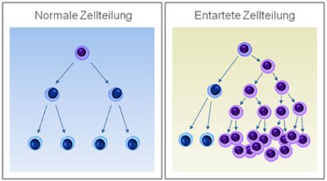 Leukemia is a cancer caused by an overproduction of damaged white blood cells. Das Krankheitsbild Leukämie