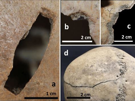 Injuries on the frontal bone (a), parietal bone (b, c) and ...