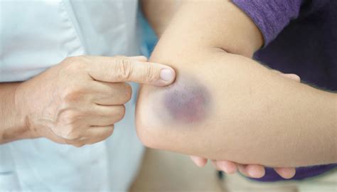 Best vitamin k supplement for bruising. 8 Things You Need to Know About Vitamin K Deficiency