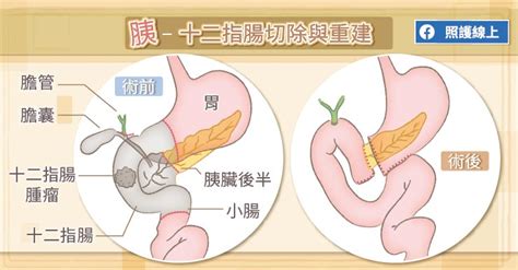 短短 4 天內，確診個案數從每天十幾二十人，一口氣增加到 15 日的 180 人確診，國內陷入前所未有的疫情緊繃，行政院長蘇貞昌以及衛福部長陳時中在今天. 肚子痛以為肌肉拉傷，確診是十二指腸癌!醫師：注意8大症狀，當心腫瘤找上門