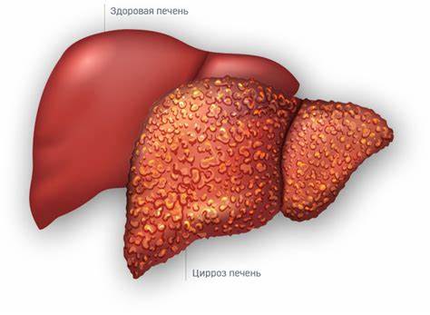 ️ Алкогольный цирроз печени: симптомы, причины, последствия | Методы Картинка - ️ Алкогольный цирроз печени: симптомы, причины, последствия | Методы