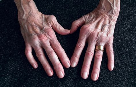 Teknik penggunaan lengan sebagai alat serang disebut dengan pukulan. Rheumatoid Arthritis Atau Yang Sering Disebut Rematik Juga ...