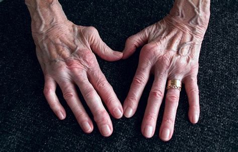 Gambar tersebut merupakan salah satu gerakan dalam melakukan senam lantai yaitu gerakan … e. Rheumatoid Arthritis Atau Yang Sering Disebut Rematik Juga ...