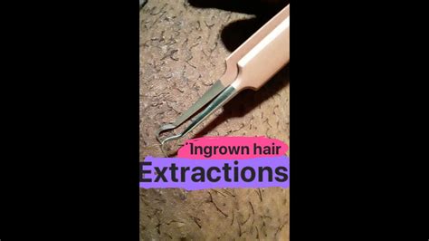 Ingrown hair cysts can be quite painful if not identified properly and provided appropriate treatment. INGROWN HAIR EXTRACTIONS!! - YouTube