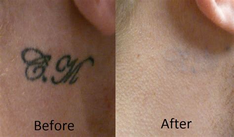 A laser tattoo removal expert can say for sure how many treatment sessions a person needs. Laser tattoo removal, 6 sessions - Symphony Beauty Clinic