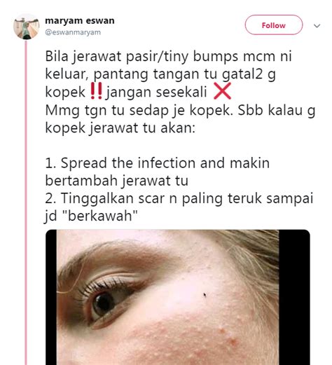 Check spelling or type a new query. Gadis Ini Dedah Cara Hilangkan Jerawat Dengan Cepat ...