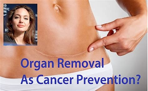 The type of ovarian cancer is based on the type of cells in which it occurs. Beware of Organ Removal for "Cancer Prevention": Jolie's ...