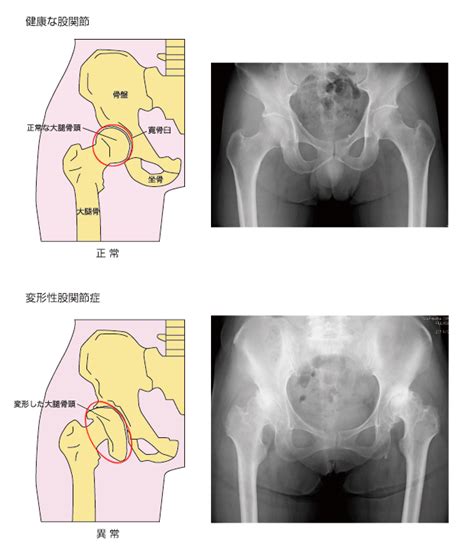 変形性股関節症 ｜大府市 整形外科｜前原整形外科 ...