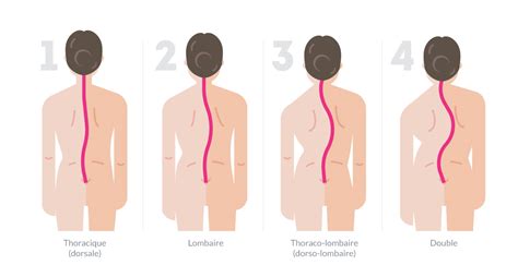 Comment savoir si on est porteur sain d'un virus ? Scoliose - Giglio Orthopédie | scolioses.ch