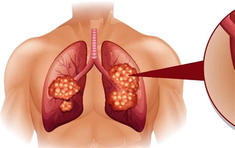 This can cause secondary symptoms. Treatment For Lung Cancer Stage 4 - CancerOz