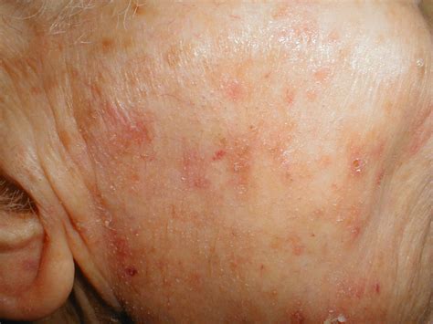 Maybe you would like to learn more about one of these? Actinic keratosis - Pictures, Causes, Symptoms and Treatment