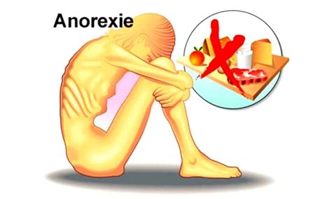 L'anorexie mentale n'est pas une maladie aiguë qui apparaît brusquement. Anorexie mentale : causes, symptômes et traitements ...