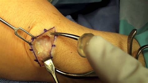 How not to treat a ganglion. Pin on Miscellaneous